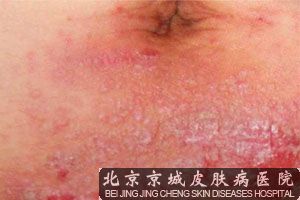 过敏性湿疹症状