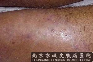 毛囊炎患者怎么养成良好的生活习惯