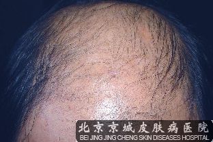 掉头发是怎么回事