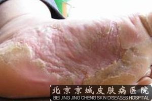 用足粉治疗手足癣应注意什么