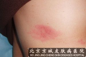 带状疱疹用什么药