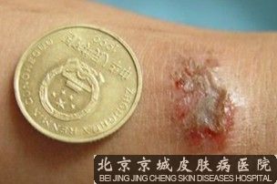 念珠菌性皮炎的防治
