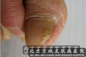 女性预防灰指甲的方法
