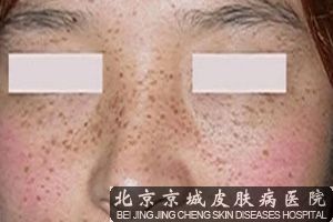 雀斑是怎么回事