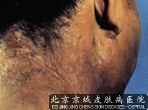 神经性皮炎怎么回事
