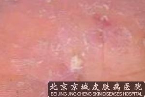 怎么判断自己是否患了手足癣