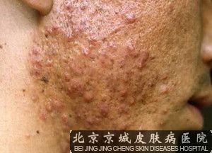 什么是痤疮