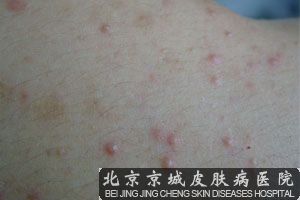 腿部毛囊炎有什么症状