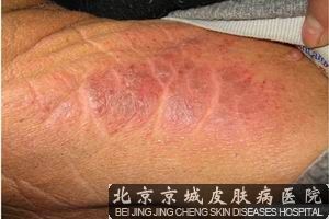 湿疹症状什么样