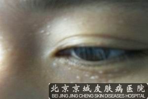 汗管瘤怎么治疗