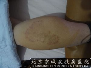 如何治神经性皮炎