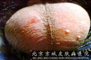 北京治疗阴囊皮炎专业的医院