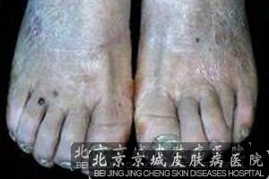 脚灰指甲的治疗偏方