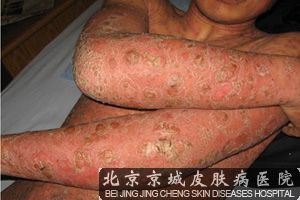 牛皮癣遗传
