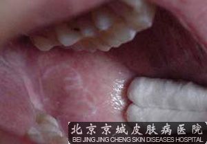 口腔扁平苔藓的治疗