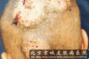 头癣如何进行传染的