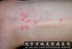 秋季如何预防过敏性荨麻疹