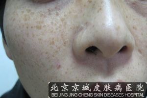 男性出现雀斑的原因