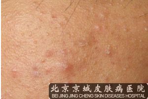 治疗青春痘要花多少钱