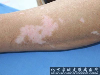 白癜风能靠偏方来治疗吗