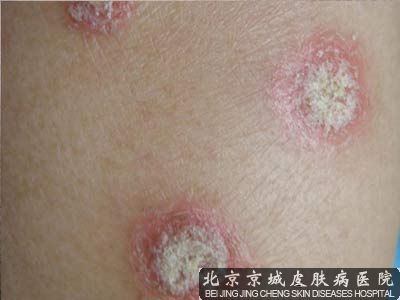 牛皮癣如何防治