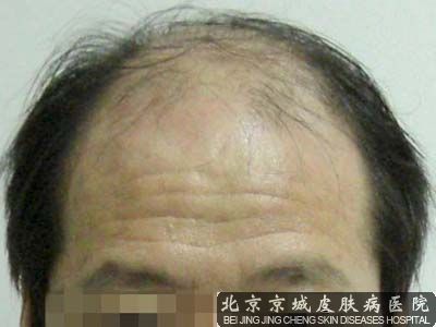 哪些病因会引起男性脱发