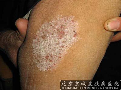 神经性皮炎如何预防