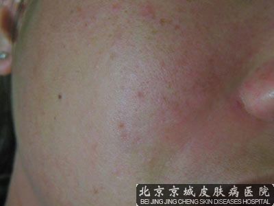 脂溢性皮炎要怎么注意
