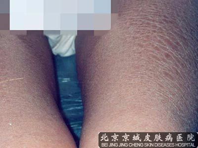 鱼鳞病都有什么症状