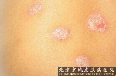 京城“中西医结合”带您进入规范治“癣”时代
