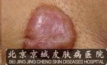 疤痕疙瘩究竟该怎么治疗