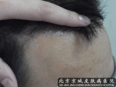 脱发是如何引发的