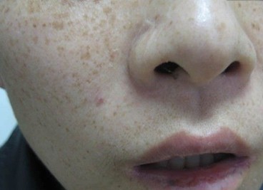 究竟如何去除雀斑呢
