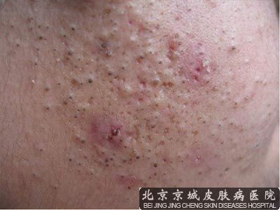 青春痘是怎么出现的