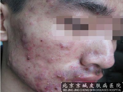 青春痘患者要如何护理