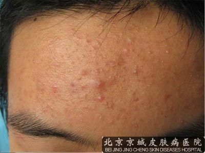 引发青春痘的因素