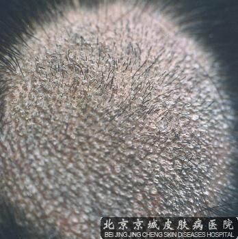 儿童要怎么预防头癣呢