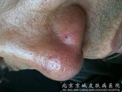 酒糟鼻的预防工作