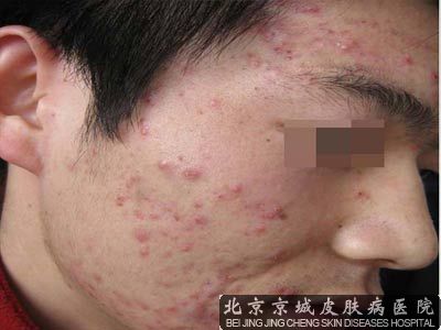 青春痘反复发作的原因