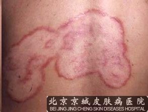 体癣有什么危害