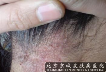 头癣发病的原因