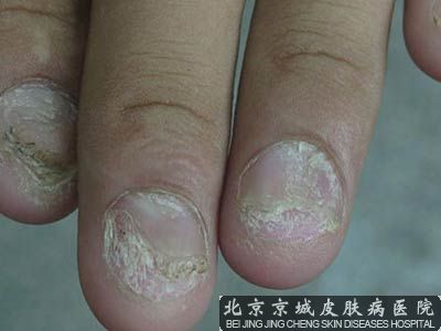 灰指甲对女性的危害有哪些
