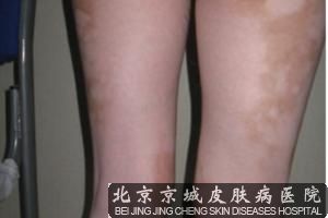 白癜风的治疗
