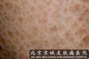 引起鱼鳞病的原因有哪些
