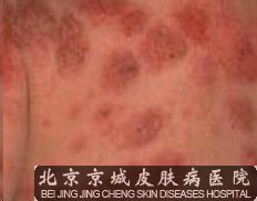 神经性皮炎的危害是什么