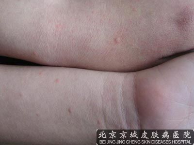 小儿丘疹性荨麻疹的注意事项