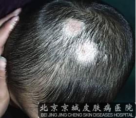 头癣的发病原因