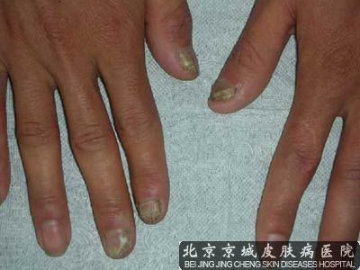 哪些病症会被误认为是灰指甲
