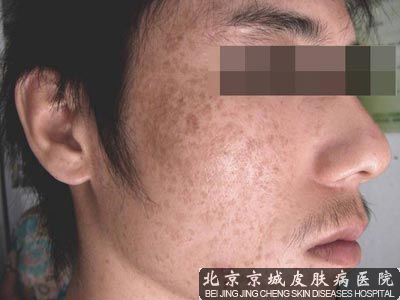 男性为什么也会长雀斑呢