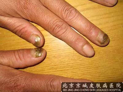 灰指甲的治疗方式